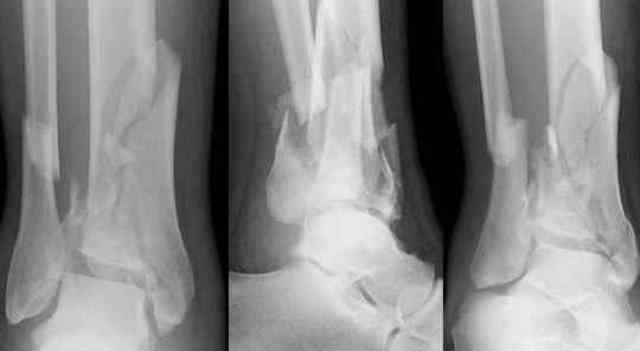 Que signifie rêver de fracture ?